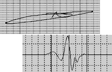 Сигналы ВТП МДФ типа 1201 от трещины после дифференциальной обработки