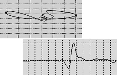 Сигнал ВТП МДФ 1201 от поры после применения дифференциальной обработки
